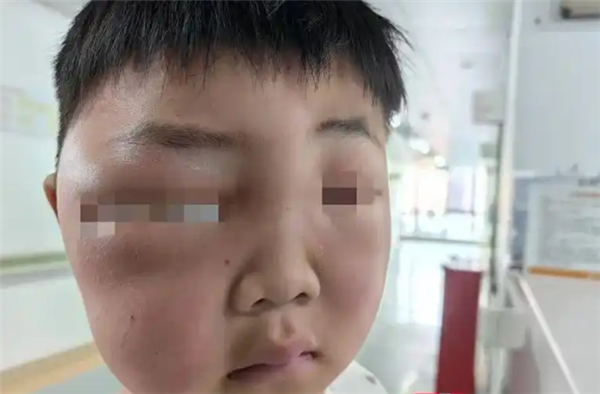 男孩一觉醒来脸肿成“发面馒头”：被蚊虫叮的面目全非